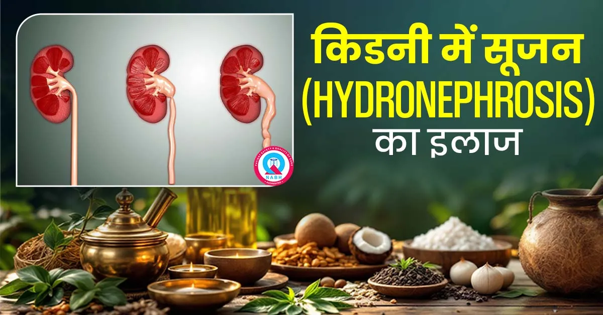 किडनी-में-सूजन-Hydronephrosis-का-इलाज